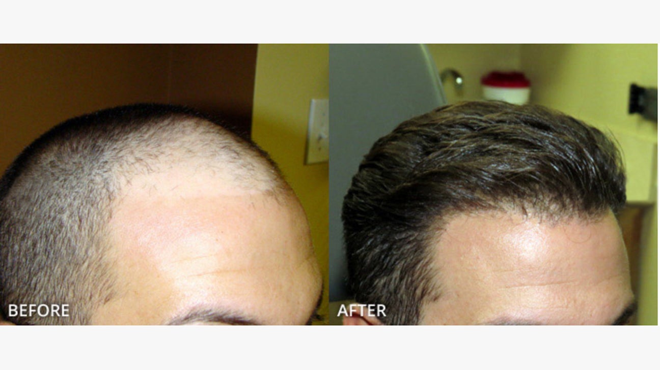 Resultado de transplante capilar FUE - antes e depois