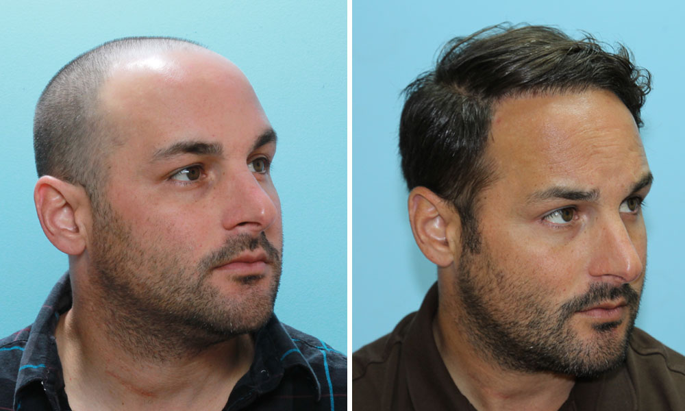 Resultado de transplante capilar FUE - antes e depois