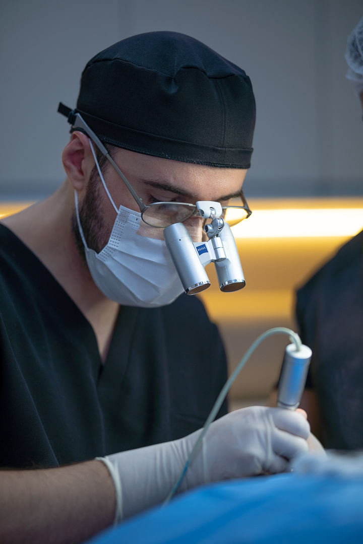 Dr. Cassyo Tornesi realizando procedimento de transplante capilar FUE