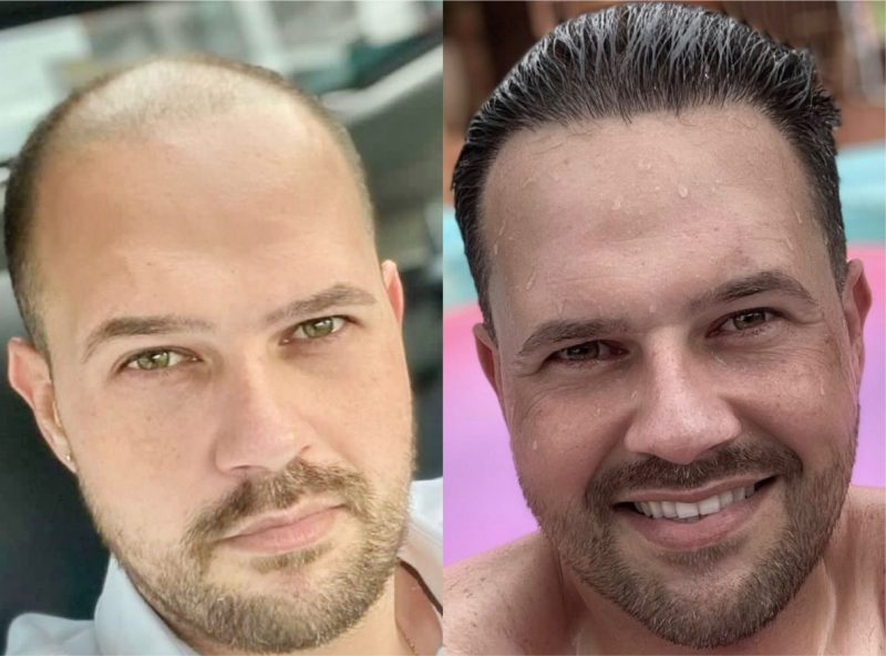 Resultado de transplante capilar FUE - antes e depois