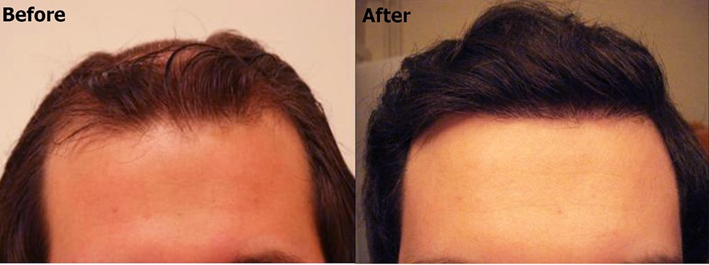 Resultado de transplante capilar FUE - antes e depois