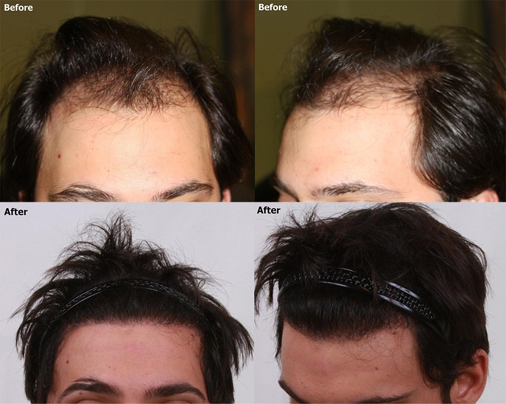 Resultado de transplante capilar FUE - antes e depois